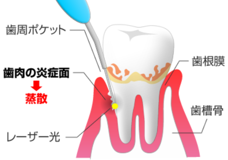 当院の歯周病治療(東大和市 歯医者 歯科 松本デンタルオフィス)