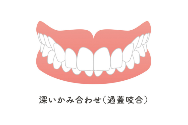 過蓋咬合（かがいこうごう）