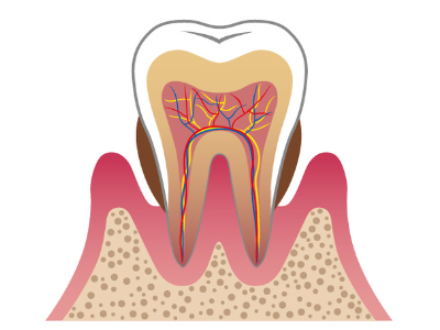 歯周病の進行過程04(東大和市 歯医者 歯科 松本デンタルオフィス)