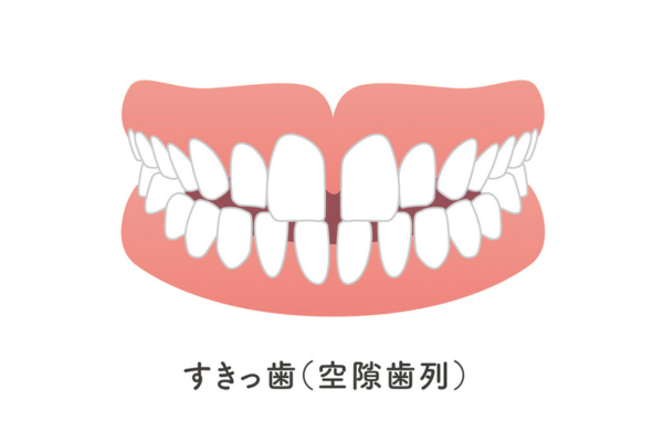 空隙歯列（くうげきしれつ）