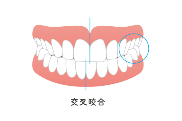 交叉咬合（こうさこうごう）