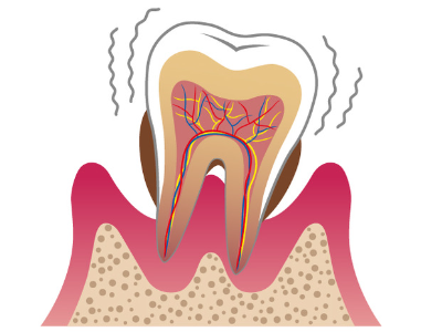 歯周病の進行過程05(東大和市 歯医者 歯科 松本デンタルオフィス)