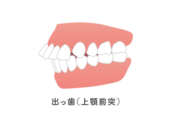 上顎前突（出っ歯）