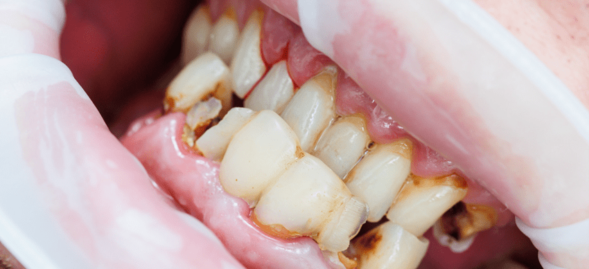 歯がボロボロに進行する過程について