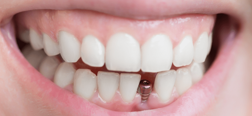 歯周病治療後のインプラントのメリット