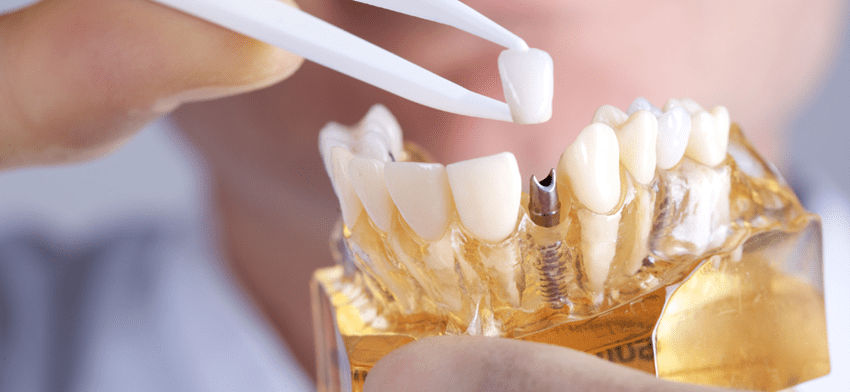 歯がボロボロの患者にとってのインプラント治療