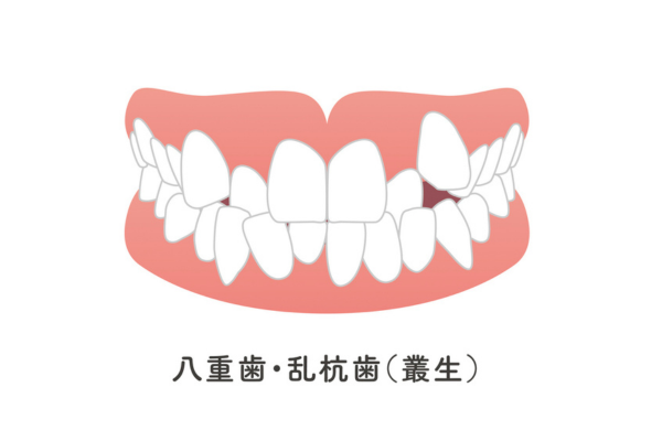 叢生（そうせい）