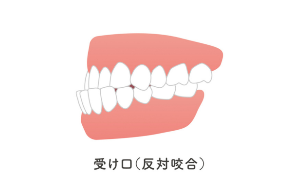 下顎前突（受け口・反対咬合）