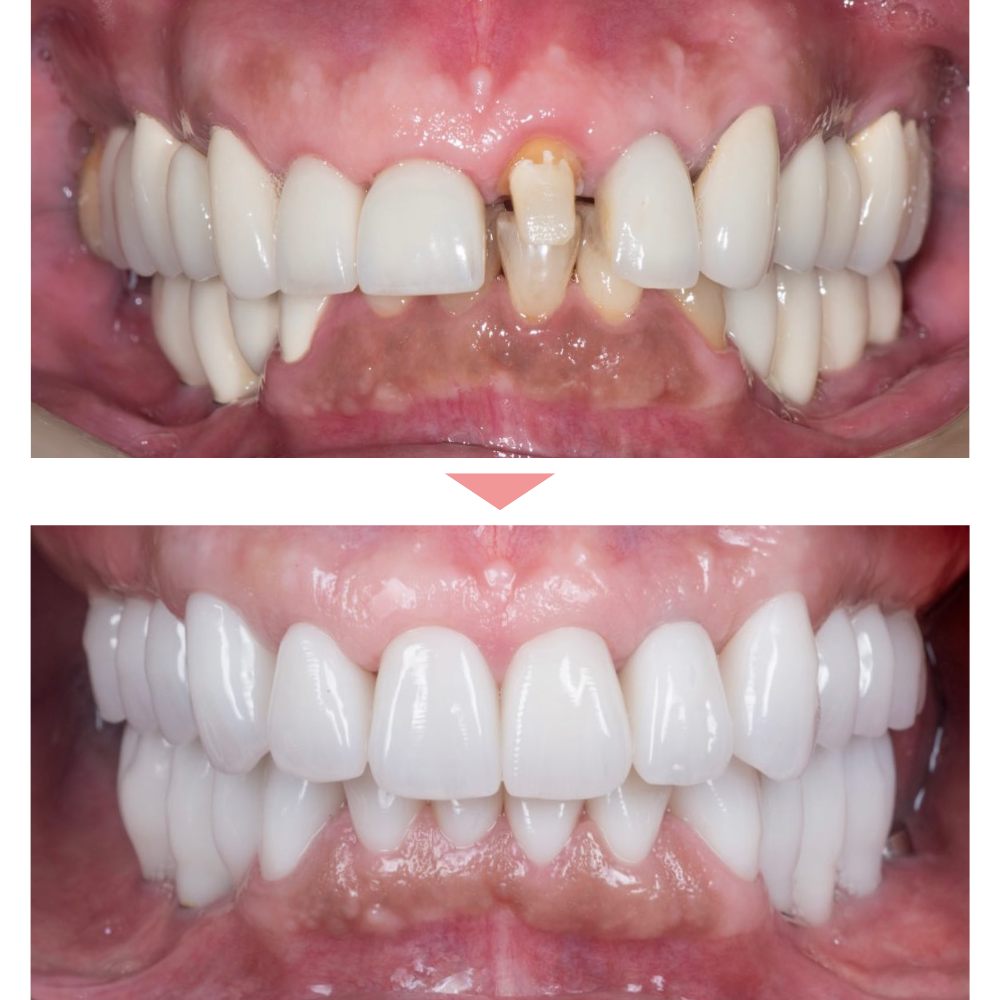 セラミック前歯