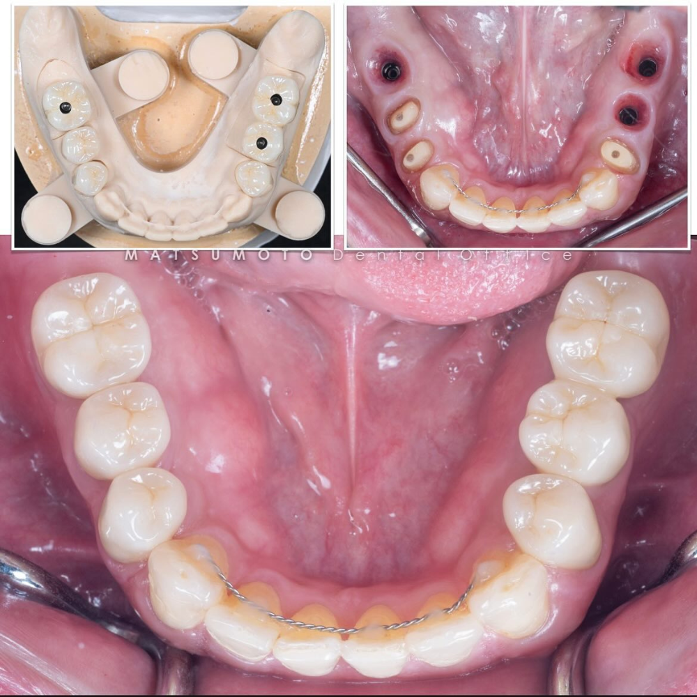 セラミック臼歯