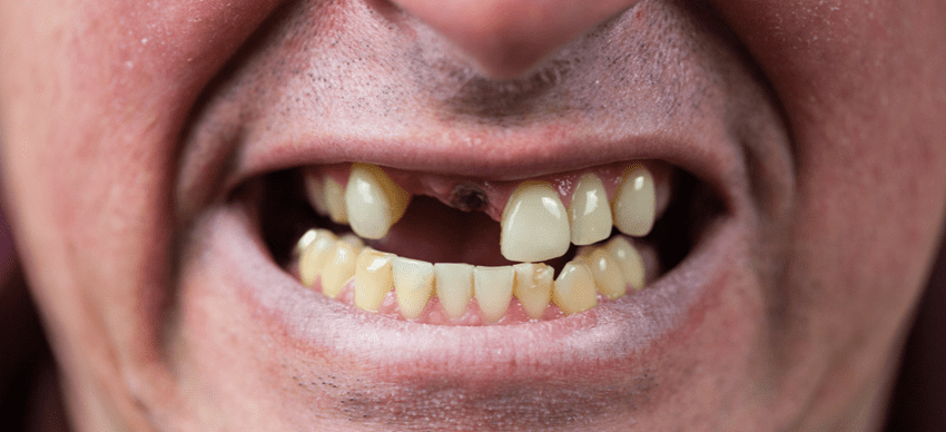 歯周病と失われた歯の関係