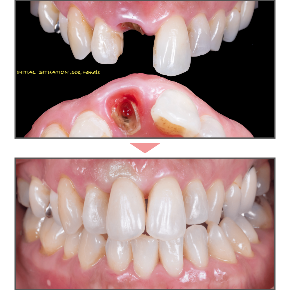 インプラント前歯