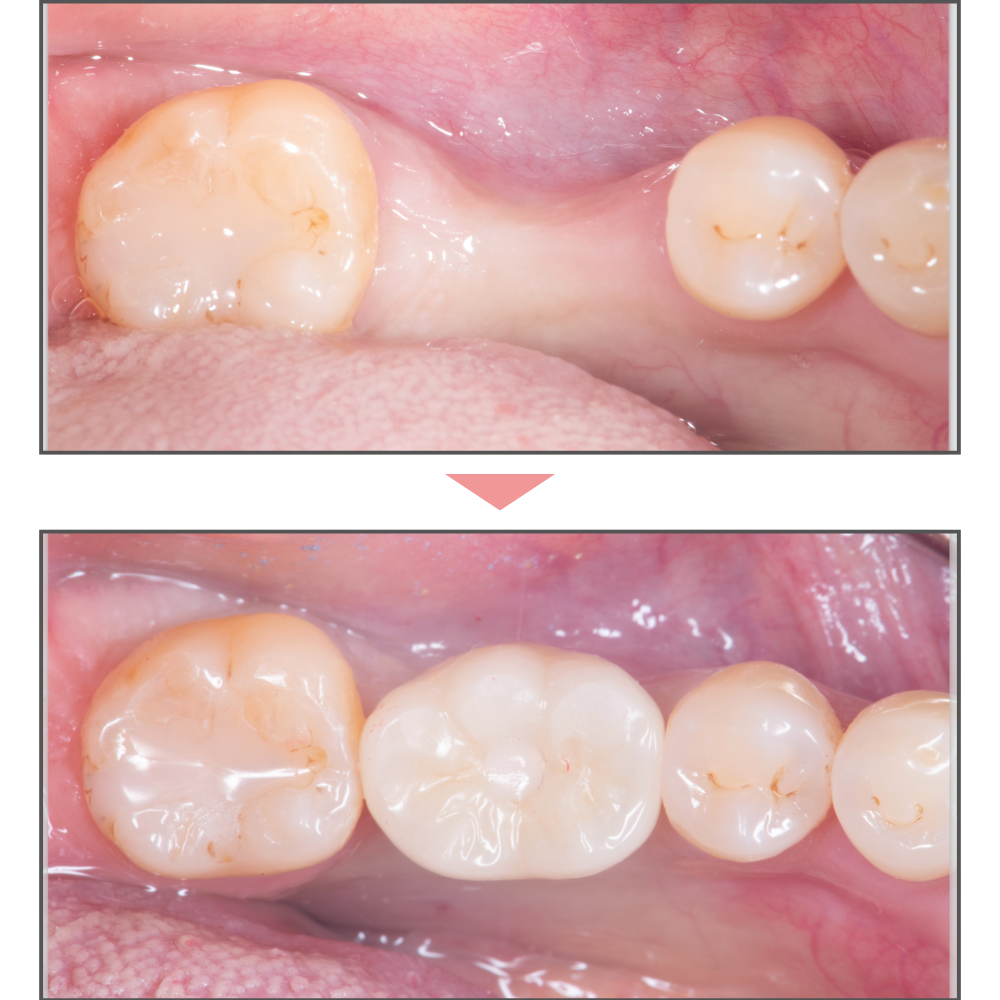 インプラント臼歯